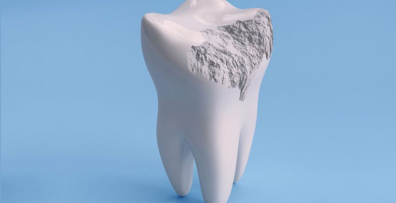 Dental Treatment Onlays